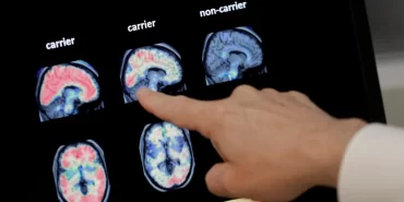 Erken Alzheimer hastalığı tespiti