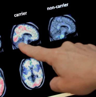 Erken Alzheimer hastalığı tespiti