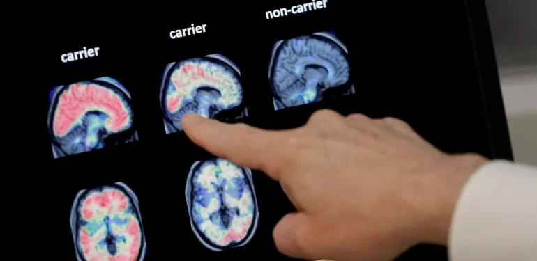 Erken Alzheimer hastalığı tespiti
