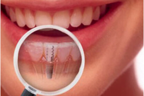 dosya-1708000980-implllant